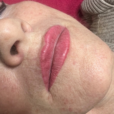 Botox und Hyaluron zugeschnitten