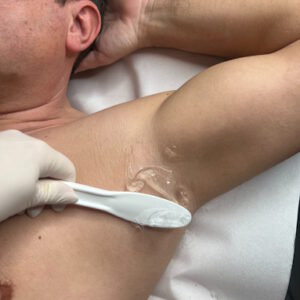 Dauerhafte Haarentfernung zugeschnitten