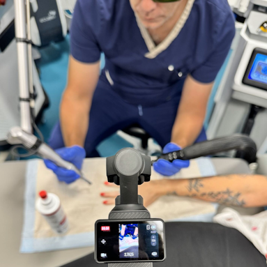 PICO Laser Behandlung zugeschnitten