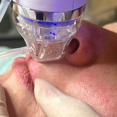 RF Micro needling Behandlung zugeschnitten Kopie 2