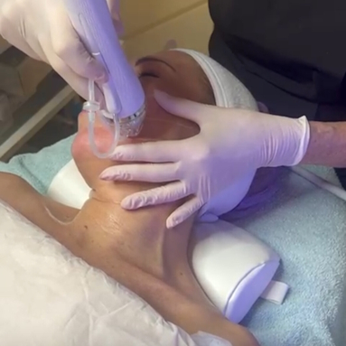 RF Micro needling Behandlung zugeschnitten Kopie 3