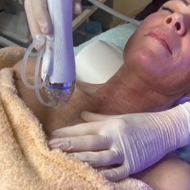 RF Micro needling Behandlung zugeschnitten Kopie 4