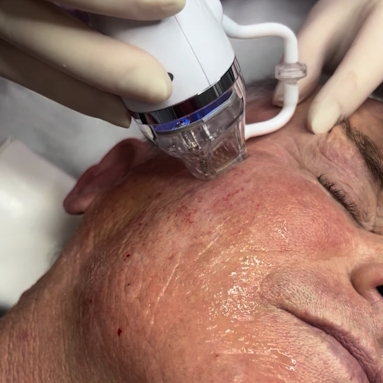 RF Micro needling Behandlung zugeschnitten Kopie 5